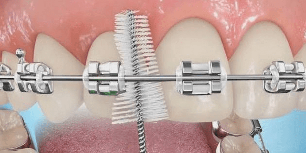 Брекеты зло? Есть ли что-то правдивое в словах «экспертов из
