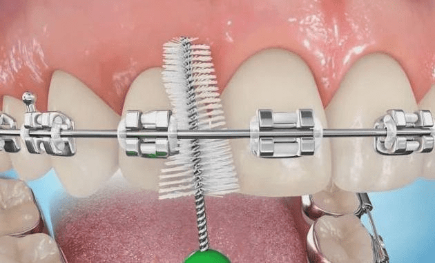 Брекеты зло? Есть ли что-то правдивое в словах «экспертов из