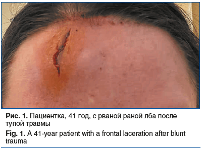 Рис. 1. Пациентка, 41 год, с рваной раной лба после тупой травмы Fig. 1. A 41-year patient with a frontal laceration after blunt trauma