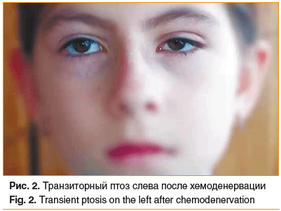 Рис. 2. Транзиторный птоз слева после хемоденервации Fig. 2. Transient ptosis on the left after chemodenervation