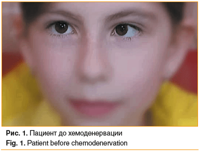 Рис. 1. Пациент до хемоденервации Fig. 1. Patient before chemodenervation