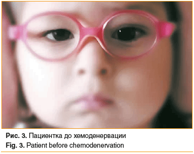 Рис. 3. Пациентка до хемоденервации Fig. 3. Patient before chemodenervation