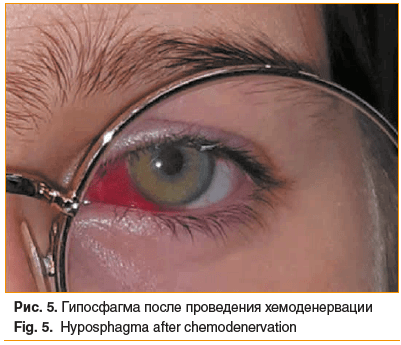 Рис. 5. Гипосфагма после проведения хемоденервации Fig. 5. Hyposphagma after chemodenervation
