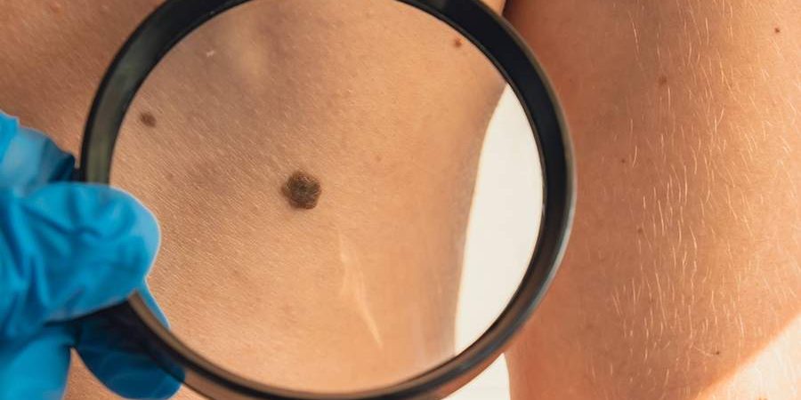 Онколог перечислил категории людей в группе риска меланомы