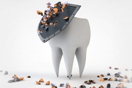 Стоп, кариес: в НИТУ МИСИС предложили новое решение для лечения зубов