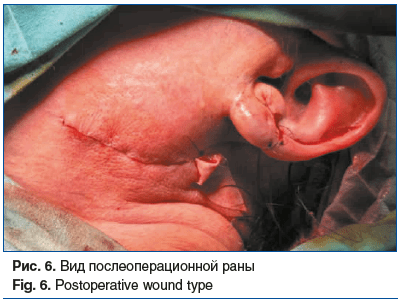 Рис. 6. Вид послеоперационной раны Fig. 6. Postoperative wound type