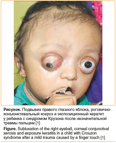 Рисунок. Подвывих правого глазного яблока, роговично- конъюнктивальный ксероз и экспозиционный кератит у ребенка с синдромом Крузона после незначительной травмы пальцем [1] Figure. Subluxation of the right eyeball, corneal conjunctival xerosis and exposur