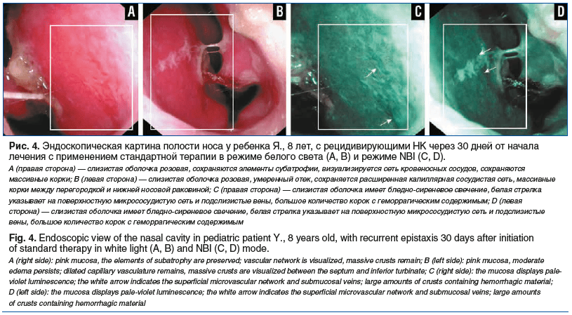 Fig. 3. Endoscopic view of the nasal cavity in pediatric patient Y., 8 years old, with recurrent epistaxis before treatment in white light (A, B) and NBI (C, D) mode.