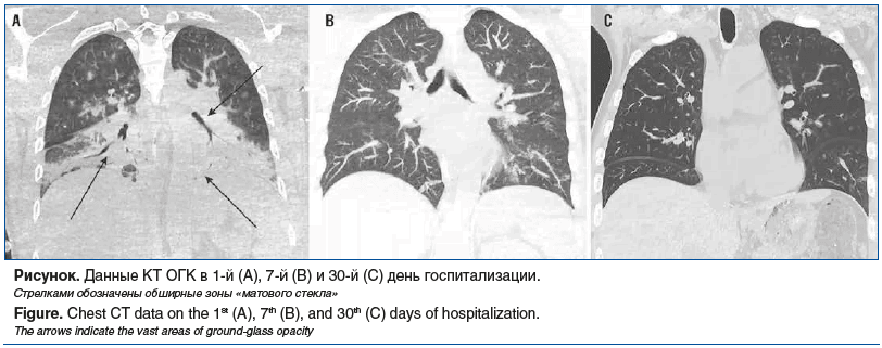 Рисунок. Данные КТ ОГК в 1-й (А), 7-й (В) и 30-й (С) день госпитализации. Стрелками обозначены обширные зоны «матового стекла» Figure. Chest CT data on the 1st (A), 7th (B), and 30th (C) days of hospitalization. The arrows indicate the vast areas of groun