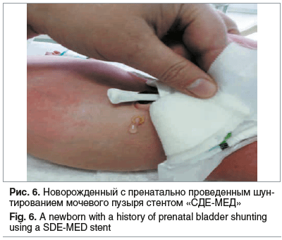 Рис. 6. Новорожденный с пренатально проведенным шун- тированием мочевого пузыря стентом «СДЕ-МЕД» Fig. 6. A newborn with a history of prenatal bladder shunting using a SDE-MED stent