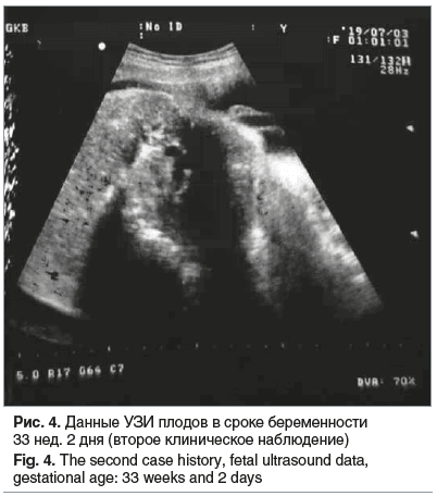 Рис. 4. Данные УЗИ плодов в сроке беременности 33 нед. 2 дня (второе клиническое наблюдение) Fig. 4. The second case history, fetal ultrasound data, gestational age: 33 weeks and 2 days
