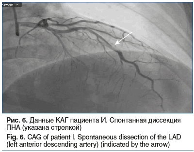 Рис. 6. Данные КАГ пациента И. Спонтанная диссекция ПНА (указана стрелкой) Fig. 6. CAG of patient I. Spontaneous dissection of the LAD (left anterior descending artery) (indicated by the arrow)