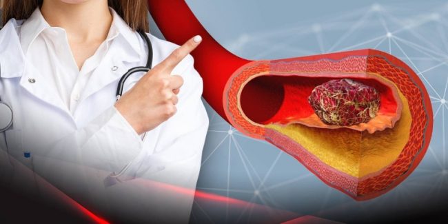 Как предотвратить тромбоз? Топ-5 способов профилактики