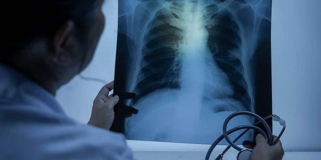 Россиянам раскрыли три главных фактора риска рака легкого