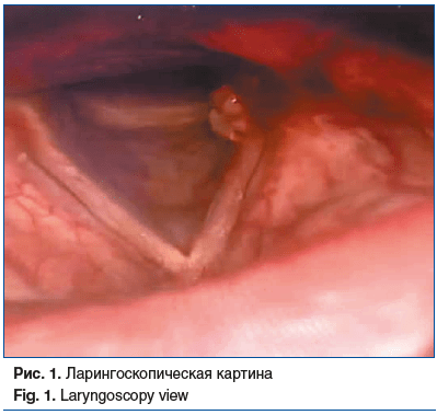 Рис. 1. Ларингоскопическая картина Fig. 1. Laryngoscopy view