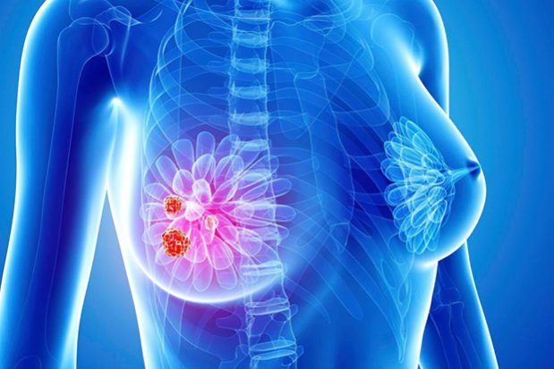 Cancer Medicine: лекарства от изжоги снижают выживаемость при раке груди