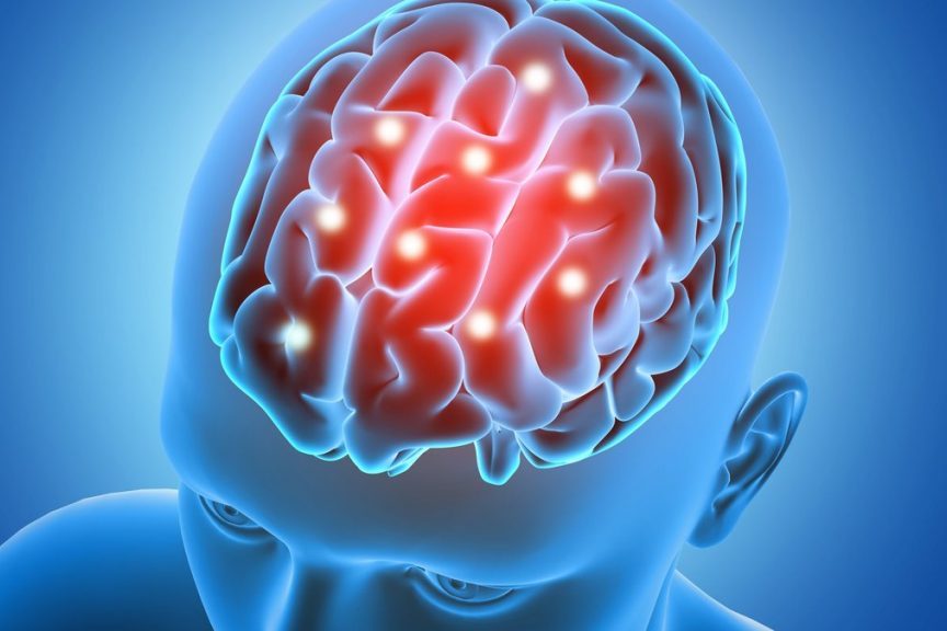 Ультразвук может повысить выживаемость после инсульта, очищая мозг