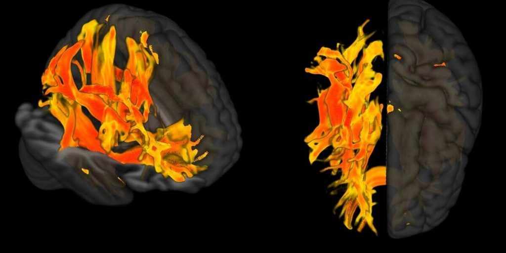 Высокое кровяное давление влияет на мозг раньше, чем считалось