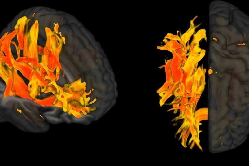 Высокое кровяное давление влияет на мозг раньше, чем считалось