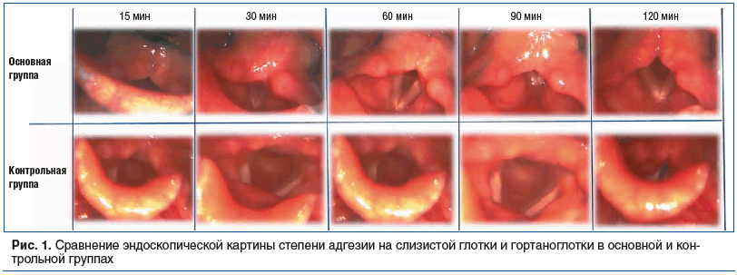Рис. 1. Сравнение эндоскопической картины степени адгезии на слизистой глотки и гортаноглотки в основной и контрольной группах Рис. 1. Сравнение эндоскопической картины степени адгезии на слизистой глотки и гортаноглотки в основной и контрольной группах