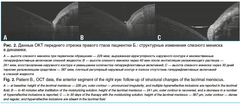 Рис. 2. Данные ОКТ переднего отрезка правого глаза пациентки Б.: структурные изменения слезного мениска в динамике. А — высота слезного мениска при первичном обращении — 226 мкм, выраженная иррегулярность наружного контура и множественные гиперрефлективны