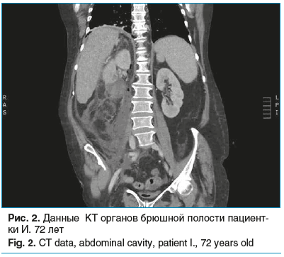 Рис. 2. Данные КТ органов брюшной полости пациент- ки И. 72 лет Fig. 2. CT data, abdominal cavity, patient I., 72 years old