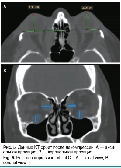Рис. 5. Данные КТ орбит после декомпрессии: A — акси- альная проекция, B — корональная проекция Fig. 5. Post-decompression orbital CT: A — axial view, B — coronal view