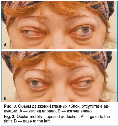 Рис. 3. Объем движений глазных яблок: отсутствие ад- дукции. А — взгляд вправо, B — взгляд влево Fig. 3. Ocular motility: imposed adduction. A — gaze to the right, B — gaze to the left