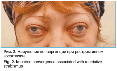 Рис. 2. Нарушение конвергенции при рестриктивном косоглазии Fig. 2. Impaired convergence associated with restrictive strabismus
