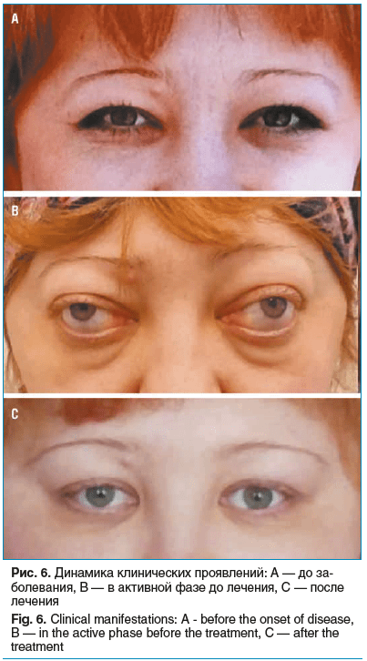 Рис. 6. Динамика клинических проявлений: A — до за- болевания, B — в активной фазе до лечения, C — после лечения Fig. 6. Clinical manifestations: A - before the onset of disease, B — in the active phase before the treatment, C — after the treatment
