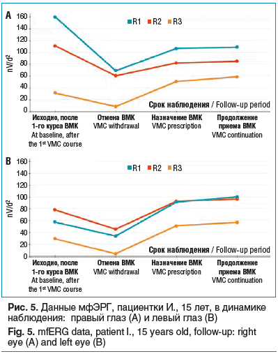Рис. 5. Данные мфЭРГ, пациентки И., 15 лет, в динамике наблюдения: правый глаз (А) и левый глаз (B) Fig. 5. mfERG data, patient I., 15 years old, follow-up: right eye (A) and left eye (B)