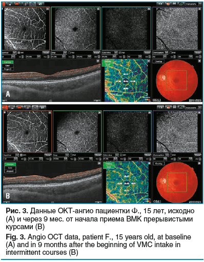 Рис. 3. Данные ОКТ-ангио пациентки Ф., 15 лет, исходно (А) и через 9 мес. от начала приема ВМК прерывистыми курсами (B) Fig. 3. Angio OCT data, patient F., 15 years old, at baseline (A) and in 9 months after the beginning of VMC intake in intermittent cou