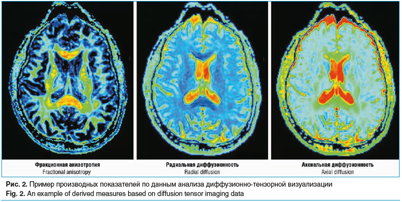 Рис. 2. Пример производных показателей по данным анализа диффузионно-тензорной визуализации Fig. 2. An example of derived measures based on diffusion tensor imaging data