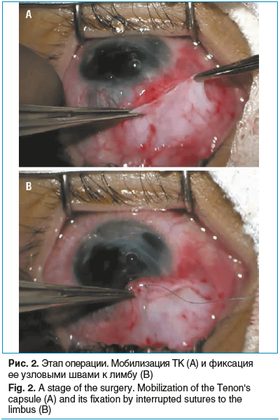 Рис. 2. Этап операции. Мобилизация ТК (A) и фиксация ее узловыми швами к лимбу (B) Fig. 2. A stage of the surgery. Mobilization of the Tenon's capsule (A) and its fixation by interrupted sutures to the limbus (B) Рис. 2. Этап операции. Мобилизация ТК (A) и фиксация ее узловыми швами к лимбу (B) Fig. 2. A stage of the surgery. Mobilization of the Tenon's capsule (A) and its fixation by interrupted sutures to the limbus (B)