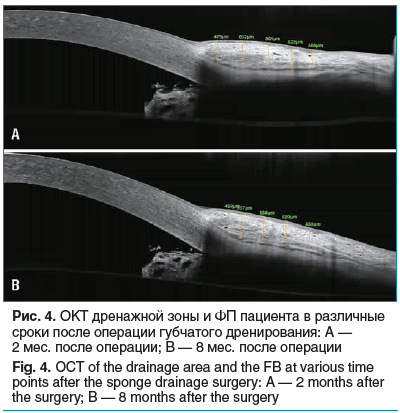 Рис. 4. ОКТ дренажной зоны и ФП пациента в различные сроки после операции губчатого дренирования: A — 2 мес. после операции; B — 8 мес. после операции Fig. 4. OCT of the drainage area and the FB at various time points after the sponge drainage surgery: A Рис. 4. ОКТ дренажной зоны и ФП пациента в различные сроки после операции губчатого дренирования: A — 2 мес. после операции; B — 8 мес. после операции Fig. 4. OCT of the drainage area and the FB at various time points after the sponge drainage surgery: A