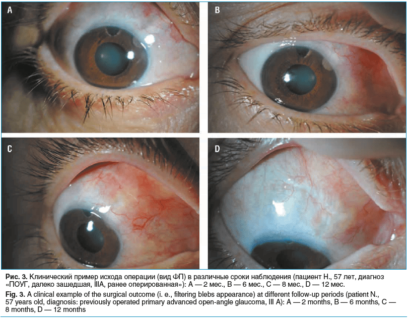 Рис. 3. Клинический пример исхода операции (вид ФП) в различные сроки наблюдения (пациент Н., 57 лет, диагноз «ПОУГ, далеко зашедшая, IIIА, ранее оперированная»): A — 2 мес., B — 6 мес., C — 8 мес., D — 12 мес. Fig. 3. A clinical example of the surgical o Рис. 3. Клинический пример исхода операции (вид ФП) в различные сроки наблюдения (пациент Н., 57 лет, диагноз «ПОУГ, далеко зашедшая, IIIА, ранее оперированная»): A — 2 мес., B — 6 мес., C — 8 мес., D — 12 мес. Fig. 3. A clinical example of the surgical o