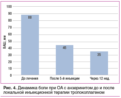 Рис. 4. Динамика боли при ОА с анзеринитом до и после локальной инъекционной терапии тропоколлагеном