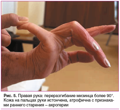 Рис. 5. Правая рука: переразгибание мизинца более 90°. Кожа на пальцах руки истончена, атрофична с признаками раннего старения – акрогерии Рис. 5. Правая рука: переразгибание мизинца более 90°. Кожа на пальцах руки истончена, атрофична с признаками раннего старения – акрогерии