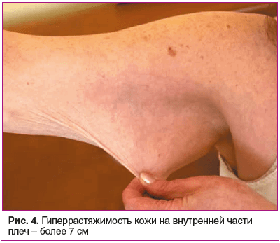 Рис. 4. Гиперрастяжимость кожи на внутренней части плеч – более 7 см Рис. 4. Гиперрастяжимость кожи на внутренней части плеч – более 7 см