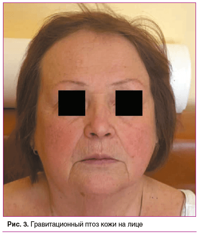 Рис. 3. Гравитационный птоз кожи на лице Рис. 3. Гравитационный птоз кожи на лице