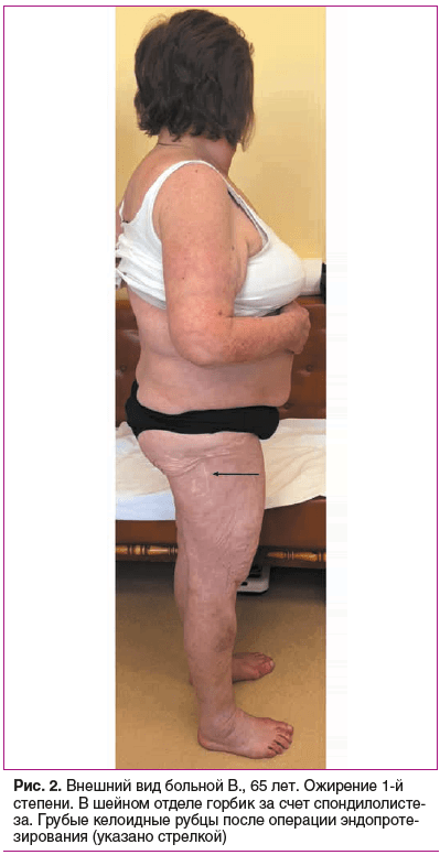 Рис. 2. Внешний вид больной В., 65 лет. Ожирение 1-й степени. В шейном отделе горбик за счет спондилолисте- за. Грубые келоидные рубцы после операции эндопротезирования (указано стрелкой) Рис. 2. Внешний вид больной В., 65 лет. Ожирение 1-й степени. В шейном отделе горбик за счет спондилолисте- за. Грубые келоидные рубцы после операции эндопротезирования (указано стрелкой)