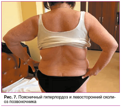 Рис. 7. Поясничный гиперлордоз и левосторонний сколи- оз позвоночника Рис. 7. Поясничный гиперлордоз и левосторонний сколи- оз позвоночника
