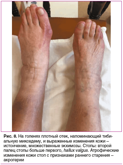 Рис. 8. На голенях плотный отек, напоминающий тиби- альную микседему, и выраженные изменения кожи – истончение, множественные экхимозы. Стопы: второй палец стопы больше первого, hallux valgus. Атрофические изменения кожи стоп с признаками раннего старения Рис. 8. На голенях плотный отек, напоминающий тиби- альную микседему, и выраженные изменения кожи – истончение, множественные экхимозы. Стопы: второй палец стопы больше первого, hallux valgus. Атрофические изменения кожи стоп с признаками раннего старения