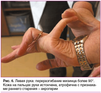 Рис. 6. Левая рука: переразгибание мизинца более 90°. Кожа на пальцах руки истончена, атрофична с признака- ми раннего старения – акрогерии Рис. 6. Левая рука: переразгибание мизинца более 90°. Кожа на пальцах руки истончена, атрофична с признака- ми раннего старения – акрогерии