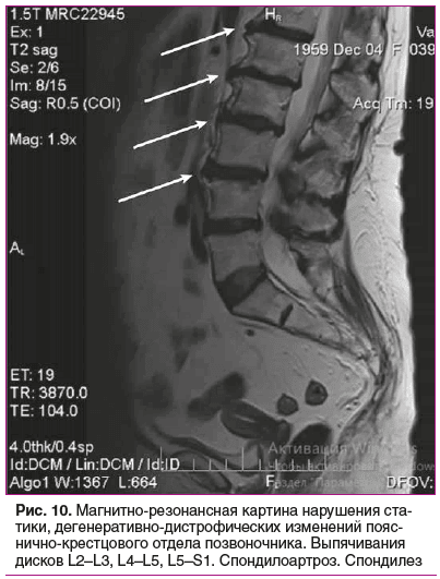 Рис. 10. Магнитно-резонансная картина нарушения ста- тики, дегенеративно-дистрофических изменений пояс- нично-крестцового отдела позвоночника. Выпячивания дисков L2–L3, L4–L5, L5–S1. Спондилоартроз. Спондилез Рис. 10. Магнитно-резонансная картина нарушения ста- тики, дегенеративно-дистрофических изменений пояс- нично-крестцового отдела позвоночника. Выпячивания дисков L2–L3, L4–L5, L5–S1. Спондилоартроз. Спондилез
