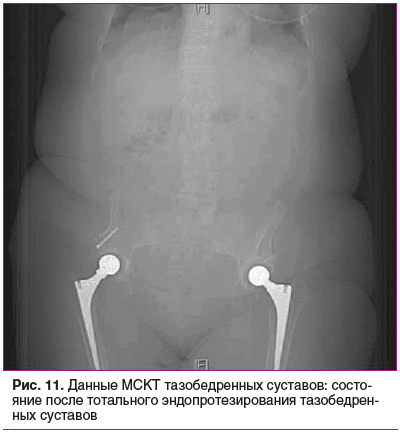 Рис. 11. Данные МСКТ тазобедренных суставов: состо- яние после тотального эндопротезирования тазобедрен- ных суставов Рис. 11. Данные МСКТ тазобедренных суставов: состо- яние после тотального эндопротезирования тазобедрен- ных суставов