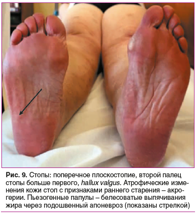 Рис. 9. Стопы: поперечное плоскостопие, второй палец стопы больше первого, hallux valgus. Атрофические изме- нения кожи стоп с признаками раннего старения – акро- герии. Пьезогенные папулы – белесоватые выпячивания жира через подошвенный апоневроз (показа Рис. 9. Стопы: поперечное плоскостопие, второй палец стопы больше первого, hallux valgus. Атрофические изме- нения кожи стоп с признаками раннего старения – акро- герии. Пьезогенные папулы – белесоватые выпячивания жира через подошвенный апоневроз (показа
