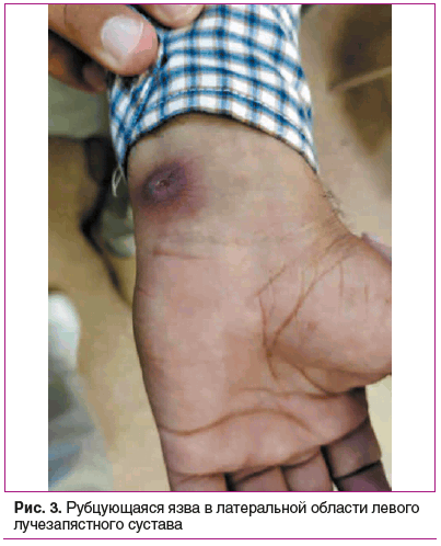 Рис. 3. Рубцующаяся язва в латеральной области левого лучезапястного сустава