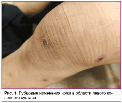 Рис. 1. Рубцовые изменения кожи в области левого коленного сустава
