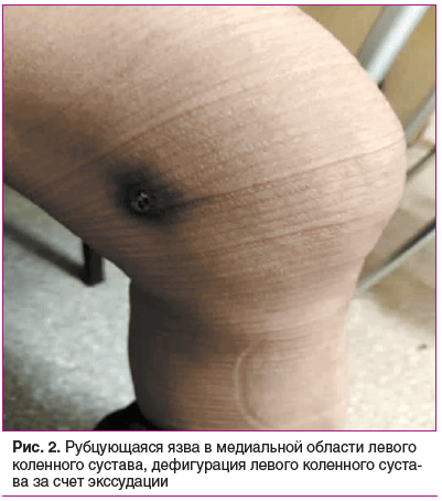 Рис. 2. Рубцующаяся язва в медиальной области левого коленного сустава, дефигурация левого коленного сустава за счет экссудации
